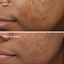 Murad Deep Relief Acne Treatment