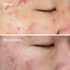 Murad Deep Relief Acne Treatment