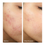 Murad InvisiScar Resurfacing Treatment